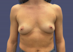 Breast Augmentation 38 Before